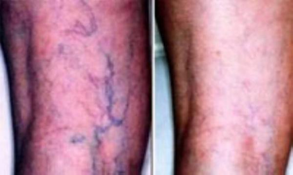 کمک های اولیه در خون ریزی از ورید های واریسی کمک های اولیه در خون ریزی از ورید های واریسی
