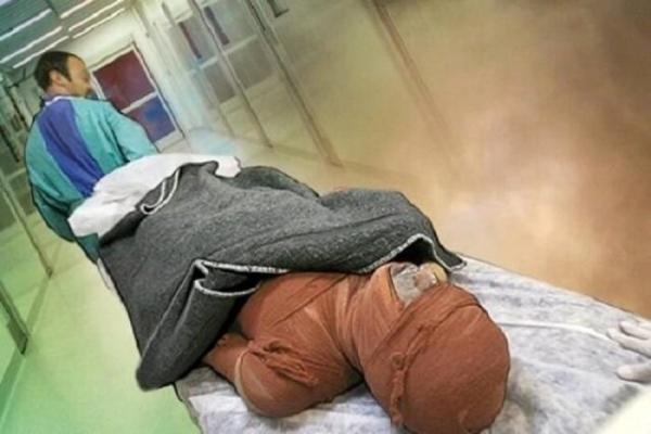 شیوع بالای مقاومت آنتی بیوتیکی در بیماران سوختگی در ایران